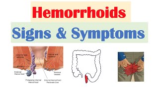 Hemorrhoids Signs amp Symptoms  Internal vs External Hemorrhoid Symptoms  Hemorrhoidal Disease [upl. by Arutak]