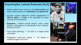 Amyotrophic Lateral Sclerosis ALS  Basics amp Clinical Presentation [upl. by Christen]