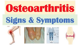 Osteoarthritis Signs amp Symptoms amp Why They Occur [upl. by Bullen]