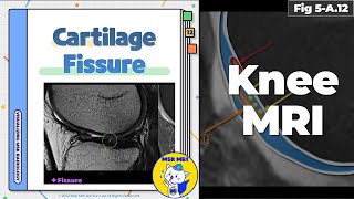 Fig 5A12 Fissure or Fissuring in Cartilage [upl. by Ataynik328]