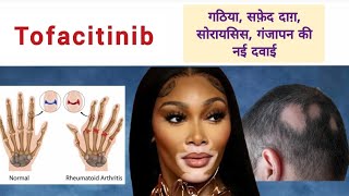 Tofacitinib गठिया सफ़ेद दाग़ सोरायसिस गंजापन की नई दवाई Rheumatoid Arthritis Psoriasis Vitiligo [upl. by Amikehs]