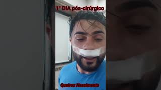 1° DIA depois da cirurgia de Desvio Do Septo Nasal [upl. by Mathews995]