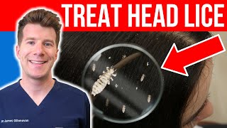 How to TREAT HEAD LICE AND NITS  Doctors stepbystep guide [upl. by Ethelin]