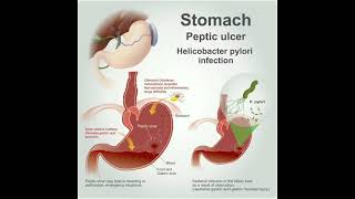 Peptic Ulcer Disease [upl. by Aitital805]