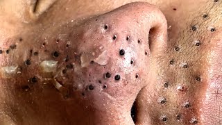 Blackhead Removal With Sac Dep Spa 1000530 [upl. by Ilek]