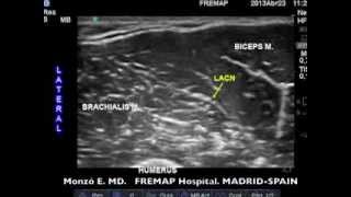 Echoanesthesia Today Lateral Antebrachial Cutaneous Nerve [upl. by Antrim672]