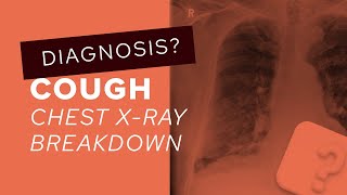 How to Interpret a Chest XRay Lesson 2  A Systematic Method and Anatomy [upl. by Irrem]