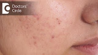 How does Microdermabrasion work for active Acne  Dr Shreeshail Kumbar [upl. by Ednil]