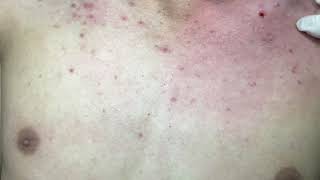 ACNE TREATMENT VU QUYNH MI Acne On Boys Chest 2024 [upl. by Miza]