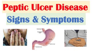 Peptic Ulcer Disease Signs amp Symptoms  Gastric vs Duodenal Ulcers [upl. by Range]