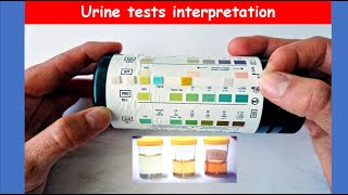 Lecture 72 Urine Analysis Tests  Interpretation [upl. by Dall170]