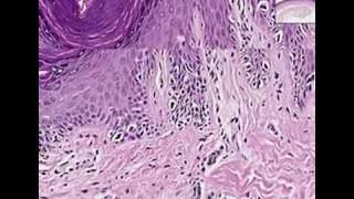 Histopathology SkinMelanoma in situ [upl. by Ahron992]