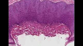 Histopathology SkinMolluscum contagiosum [upl. by Bashemeth]