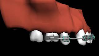 Fechamento de espaço com perda de Ancoragem  Ortodontia [upl. by Brookhouse]