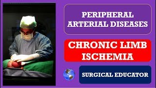 CHRONIC LOWER LIMB ISCHEMIA  How To DIAGNOSE amp TREAT Peripheral Arterial Diseases [upl. by Assyla]