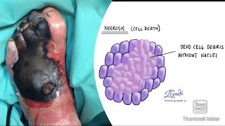 Necrosis and its types coagulative liquefactive caseous fat fibrinoid necrosis fmge neetpg [upl. by Atteloiv]