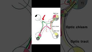 Junctional Scotoma insightophthalmology visual field ophthalmology [upl. by Krantz221]