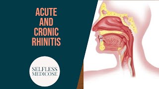 CHRONIC RHINITIS part 5 rhinitis sicca and rhinitis caseosa easy explanation [upl. by Elleinnad962]