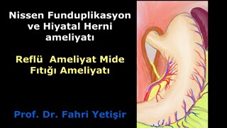 Mide Fıtığı ve reflü ameliyatı [upl. by Ramoh]