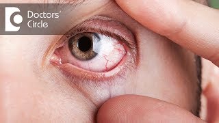 What causes visible red fine lines in eyes  Dr Elankumaran P [upl. by Eilata]