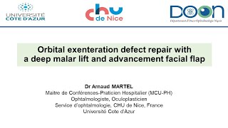 Orbital exenteration defect repair with a deep malar lift and a facial advancement flap [upl. by Collyer]