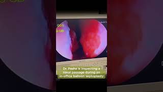 INITIAL SEPTUM amp NASAL INSPECTION  Balloon Septoplasty Part 1 [upl. by Drofdeb137]