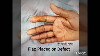 Cross Finger Flap Finger Tip Reconstruction [upl. by Gino]