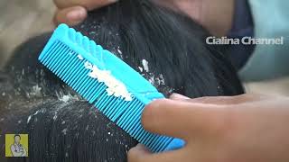 Satisfying Extremely Damaged Dandruff Scratching 2260 [upl. by Nosde]