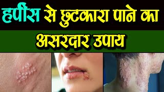 हर्पीस से छुटकारा पाने का असरदार उपाय बिना दवा बिना हाथ लगाए Herpes Virus Symptoms and Treatment [upl. by Verge949]