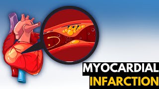 Myocardial Infarction Causes Signs and Symptoms Diagnosis and Treatment [upl. by Skardol458]