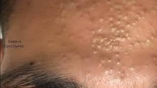 Forehead Acne amp Blackhead Treatment  Blackhead Removal on forehead removeblackhead [upl. by Kass984]