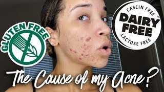 Acne Update 1  My Food Allergies [upl. by Naols971]