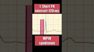 PR INTERVAL normal in AV block WPW pericarditis and atrial ischemia [upl. by Ogu241]