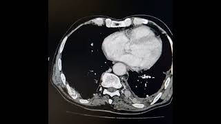 Adenocarcinoma of left lung with extrathoracic and intraspinal extension [upl. by Leland]