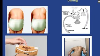 Scoliosis for the FRCS Orth exam [upl. by Runck]