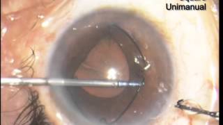 Pupil dilating ring expands realm of surgical options [upl. by Nylecyoj]