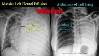 Ventricular Bigeminy [upl. by Seni]