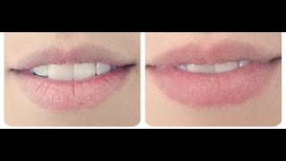 Solución de labios resecos por el uso del isotretinoina [upl. by Adyeren]