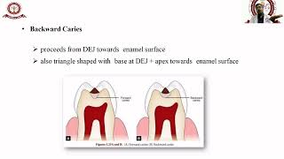 Dental Caries Classification [upl. by Noyrb]