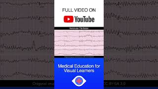 Ventricular Fibrillation ECG shorts [upl. by Anrapa]