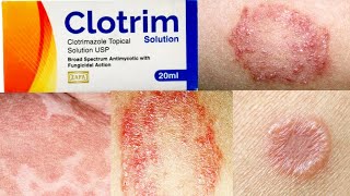 Clotrim Solution uses in Urdu Hindi  Clotrimazole  Fungal Infections [upl. by Lelith]