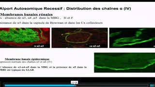 Les maladies de la membranes basale glomérulaire [upl. by Arley]