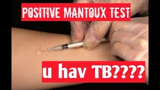 positive mantoux test tuberculin test positive result means [upl. by Aisel]