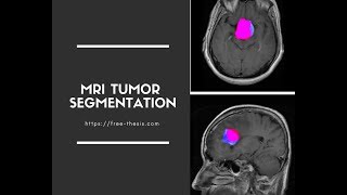 Brain MRI Tumor Segmentation in MATLAB [upl. by Haliek799]