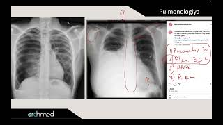 Pneumothorax vs Pleural effusion [upl. by Colas485]