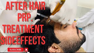 After hair PRP treatment side effects 😰 [upl. by Sidnee967]