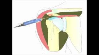 Acromioplastie arthroscopique de lépaule pour tendinite [upl. by Durtschi]