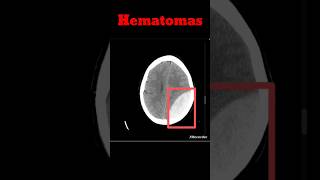 Brain Hematoma CT Brain  EDH  SDH shorts hematoma radiology brainhaemorrhage [upl. by Jacie]