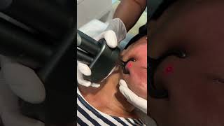 CO2 fractional laser for laser skin resurfacing [upl. by Naj595]