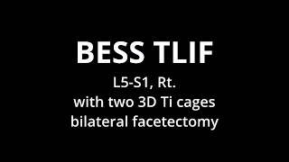 Biportal Endoscopic TLIF L5S1 Rt with two 3D Ti cages  bilateral facetectomy [upl. by Scot]